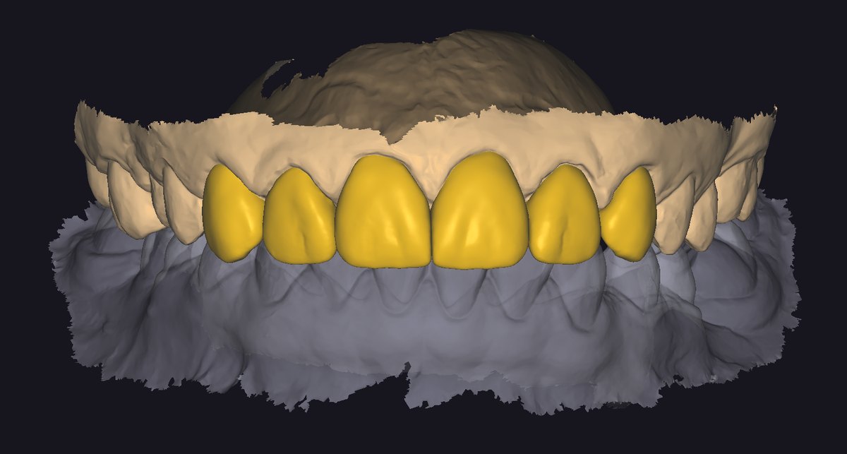 CAD design of anterior restorations over a scanned dental arch