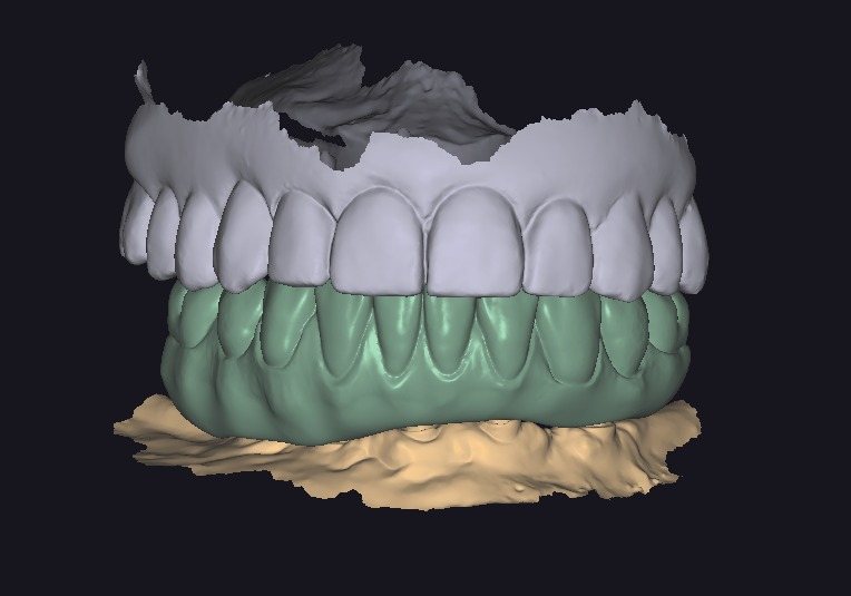 Full-arch design in occlusion, frontal view