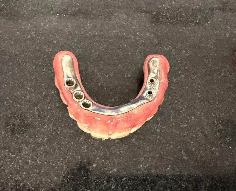 Full-arch prosthesis assembled on the titanium bar