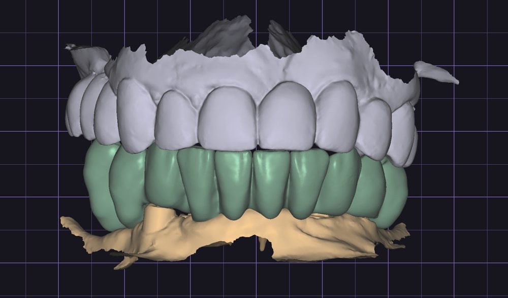 Frontal view of the full-arch CAD design