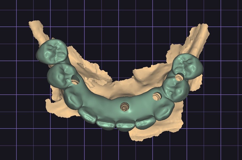 Occlusal view of the full-arch design with screw access channels