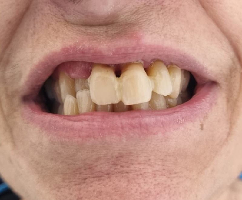 Before: irregular anterior teeth
