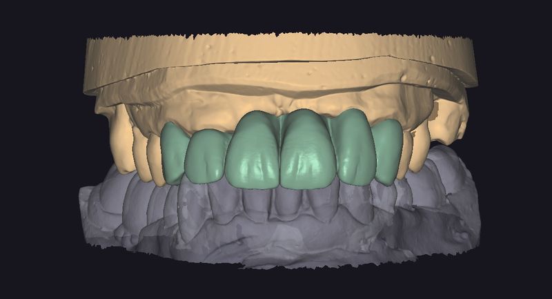CAD design of an anterior bridge, frontal view