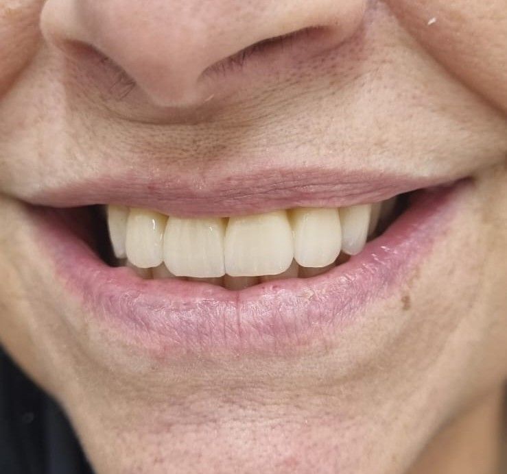 After: final anterior restoration