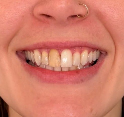 Before: discolored upper central incisor