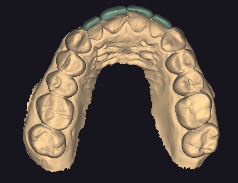CAD design of the anterior restorations, occlusal view