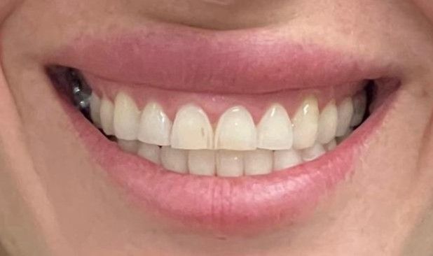 Before: worn and discolored anterior teeth