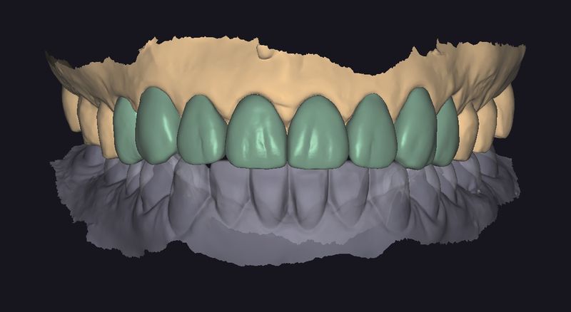 CAD design of the anterior restorations, frontal view