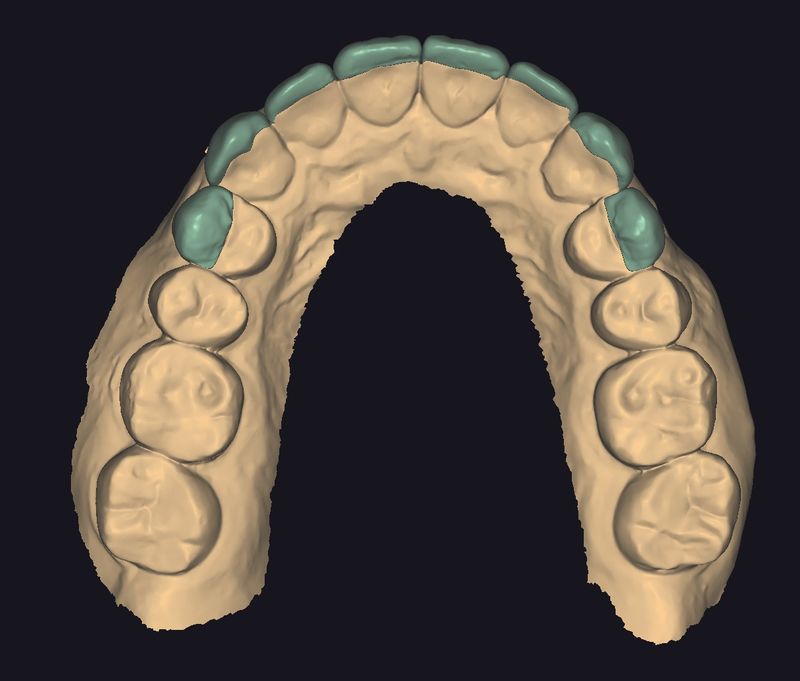 CAD design of the anterior restorations, occlusal view